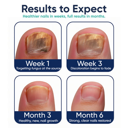 NailGuard™ Antifungal Pen – Clear, Healthy Nails in Just 14 Days